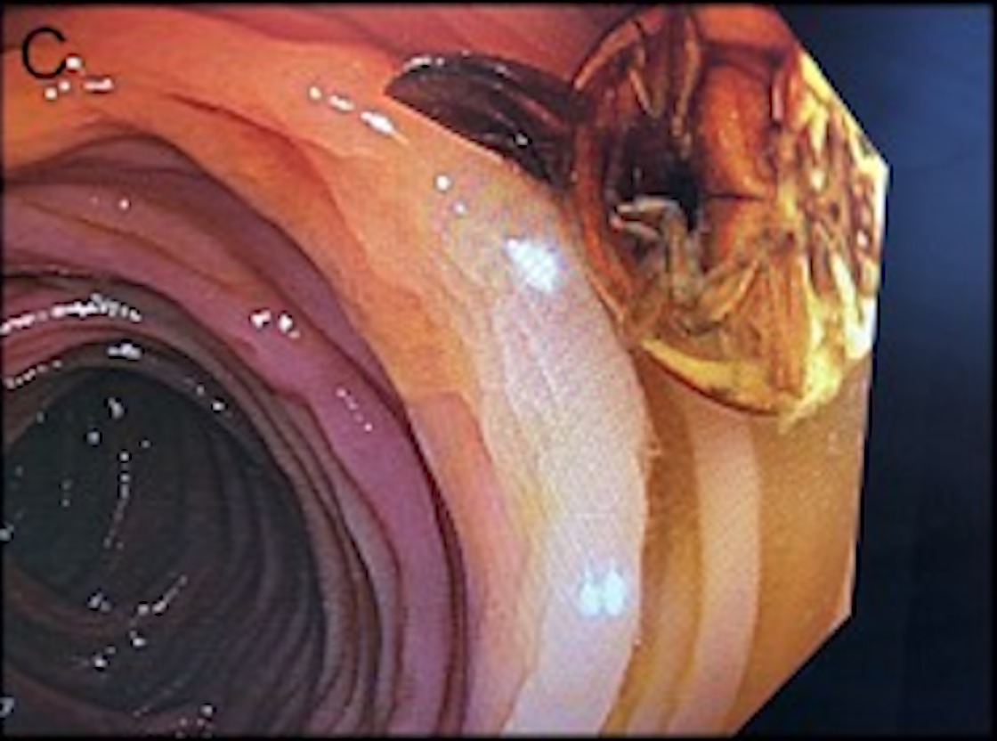 Ladybug in the intestine of a patient.