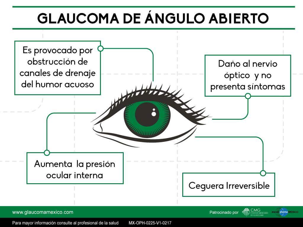 Descripción del glaucoma y sus efectos 