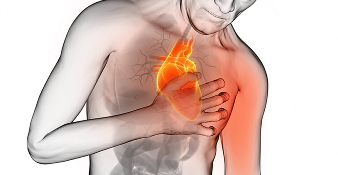 infarto al miocardio