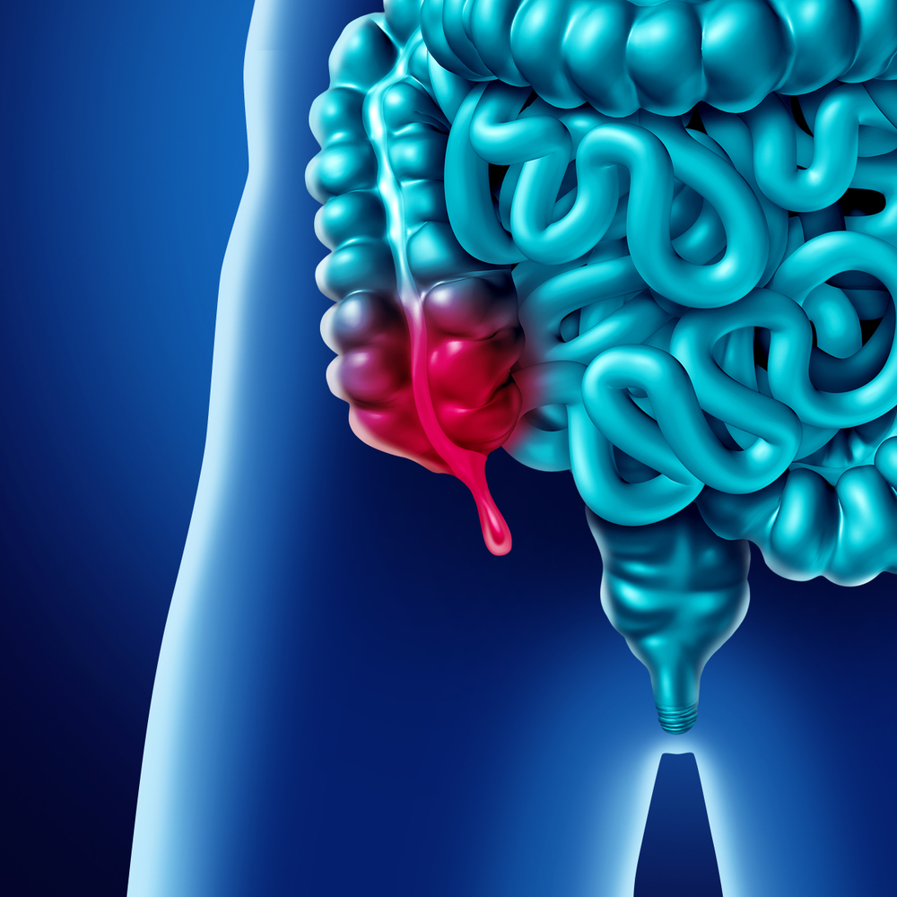 La apendicitis aumenta las probabilidades de cáncer en los hombres