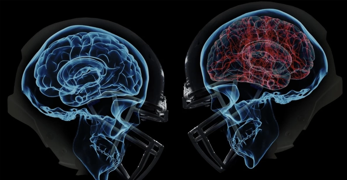 La historia del doctor que luchó contra los golpes degenerativos de la NFL