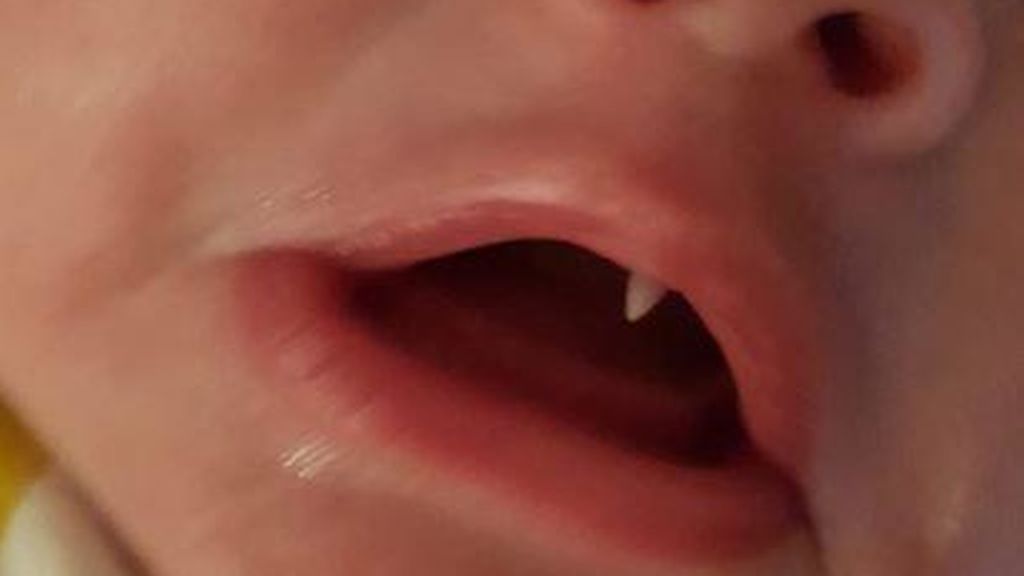  A un bebé de 11 semanas le salió un colmillo en 24 horas 