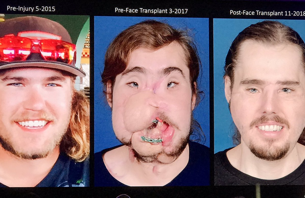 El antes y después del transplante de rostro más avanzado del mundo