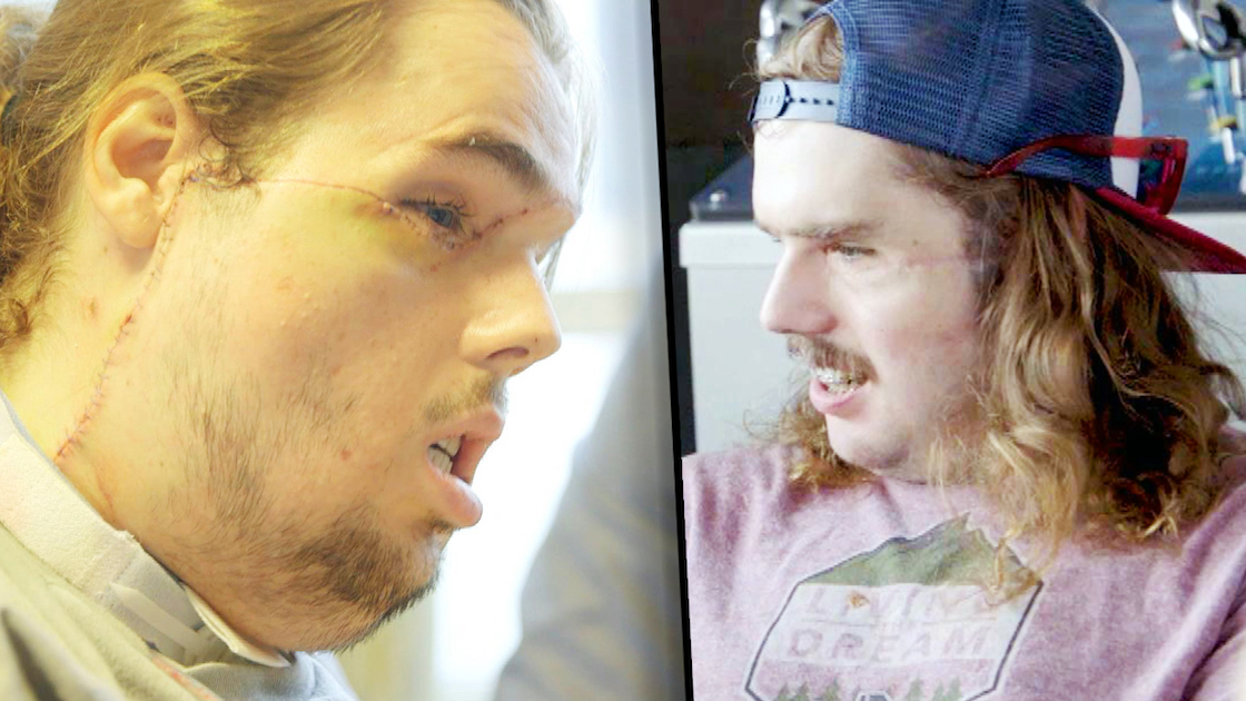 El antes y después del transplante de rostro más avanzado del mundo