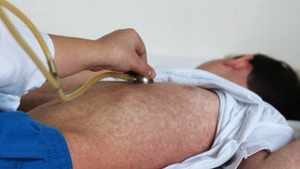 Se reporta un brote de sarampión en Costa Rica más de 10 años después: Un niño francés el sospechoso