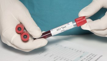 ¡Wow! Un paciente en Londres podría haberse curado de VIH; es el segundo en la historia