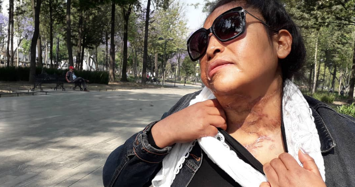 "Por andar chillando en televisión" golpearon a una mujer que había sido atacada con ácido en 2014