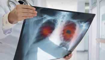 Una inteligencia artificial detecta el cáncer de pulmón con mayor precisión que los médicos