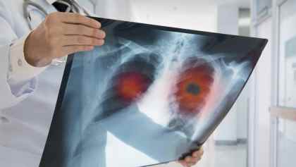 Una inteligencia artificial detecta el cáncer de pulmón con mayor precisión que los médicos