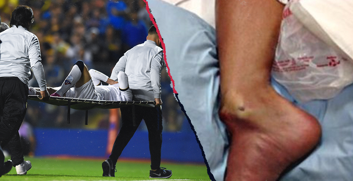 La escalofriante lesión de Christian Cruz en la Copa Libertadores