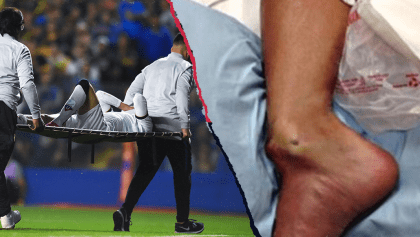 La escalofriante lesión de Christian Cruz en la Copa Libertadores