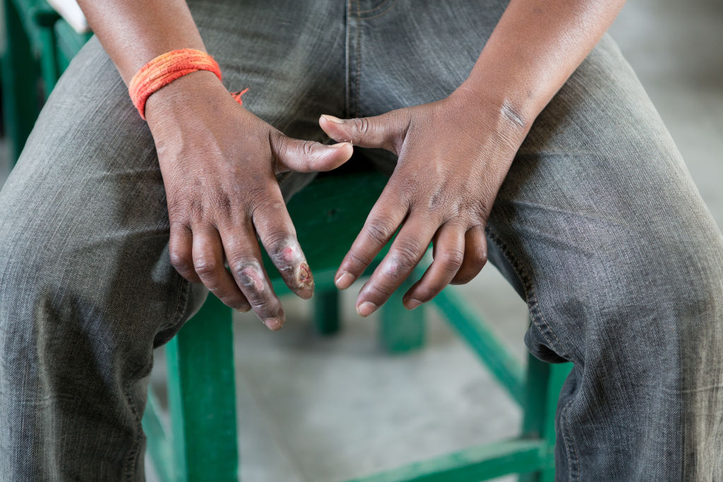 No ahora, por favor: 18 estados de la república mexicana reportan casos de lepra 