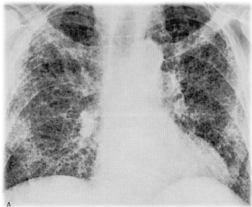 Así se ve la fibrosis pulmonar.