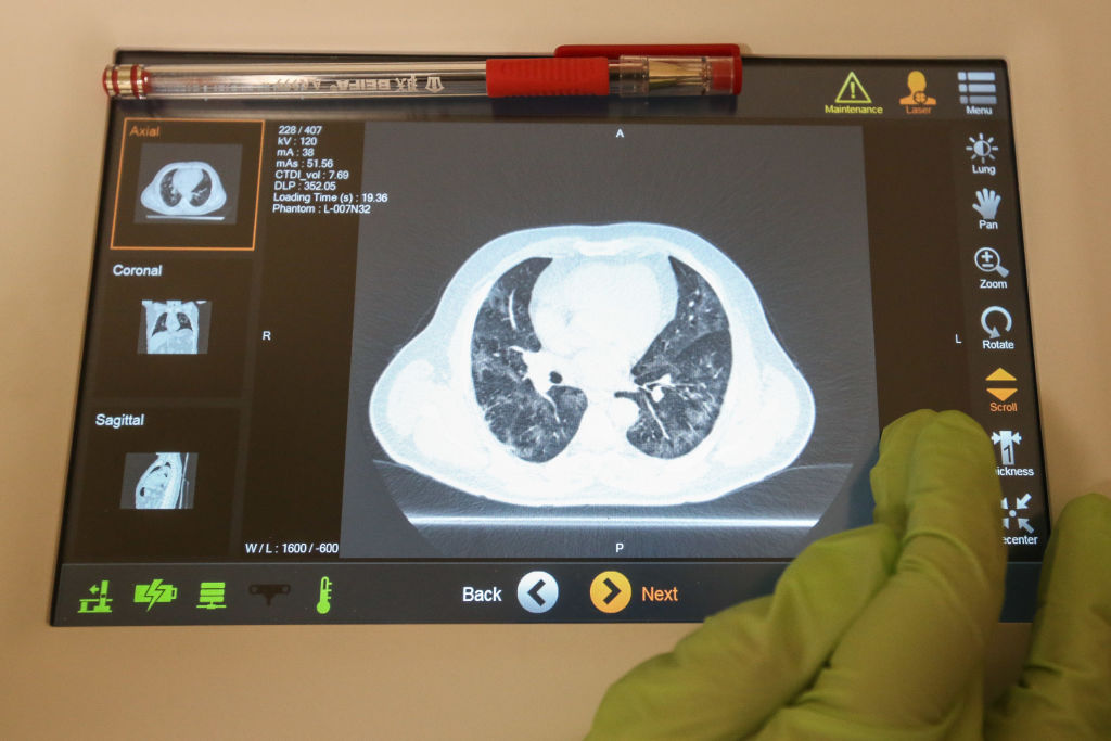 tomografía-pulmones