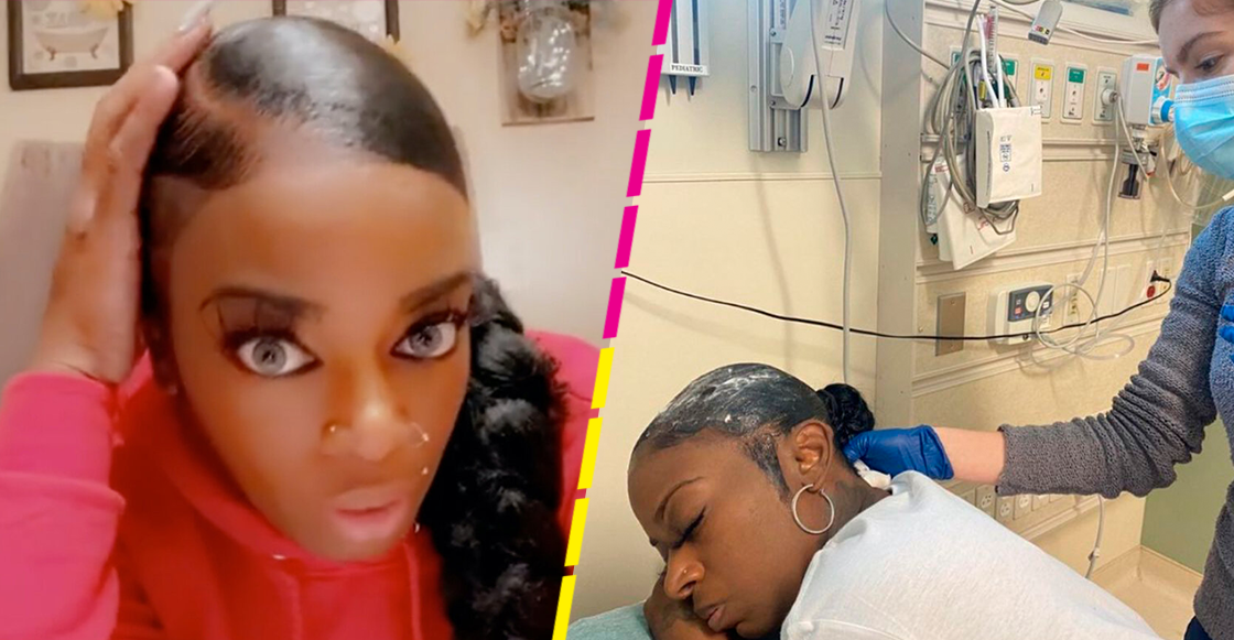 Influencer usó pegamento en lugar de spray para el cabello y terminó en el hospital