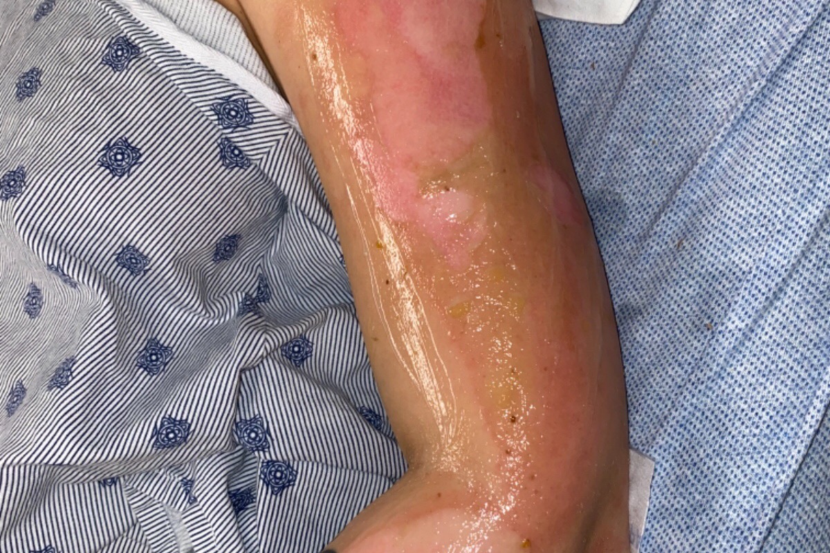 Turista termina con quemaduras en la cara durante visita a un bar de Cancún 