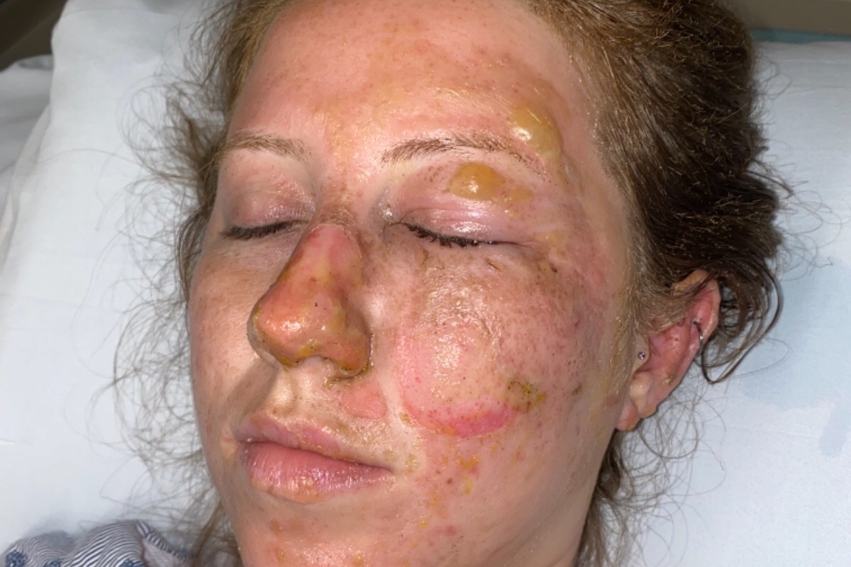 Turista termina con quemaduras en la cara durante visita a un bar de Cancún 