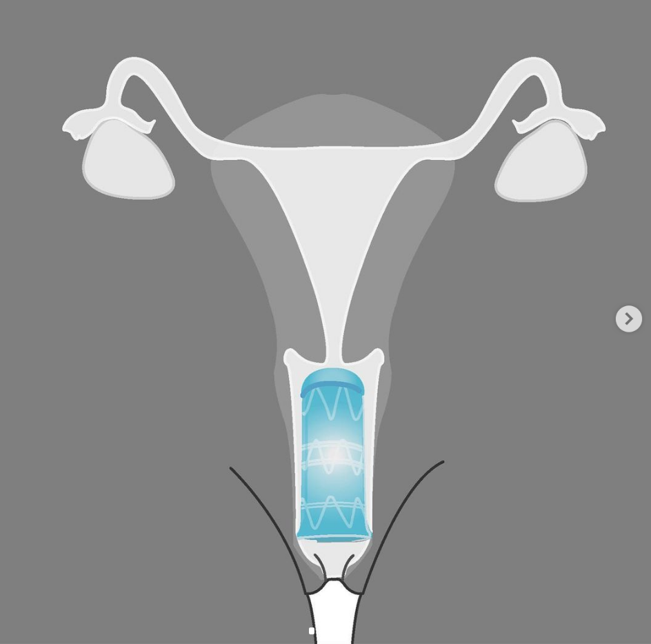 Rape-aXe: El 'condón con dientes' que busca evitar violaciones a mujeres