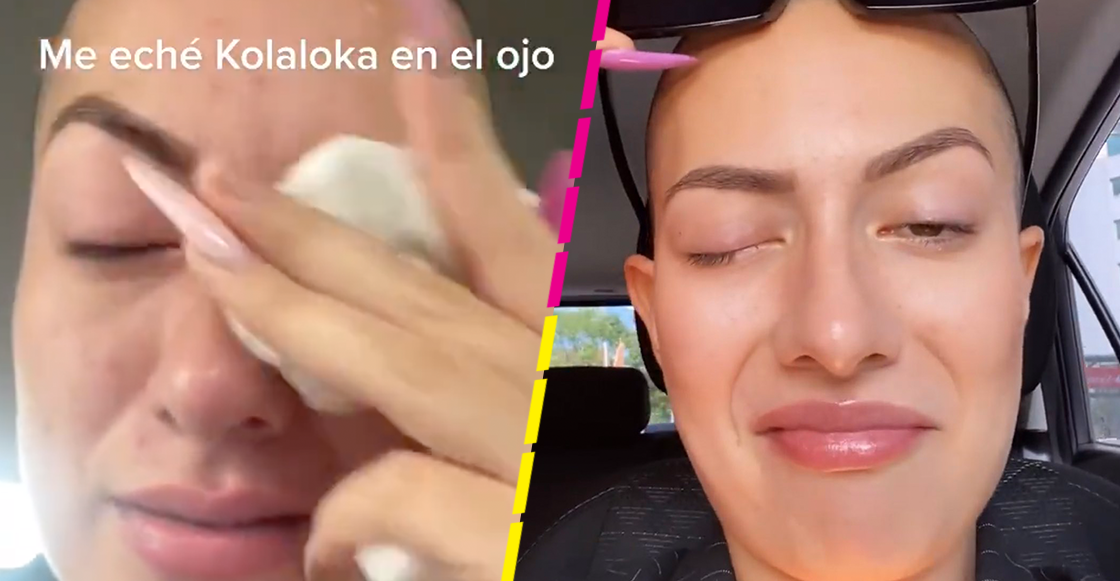 Tiktoker se echa pegamento en los ojos... porque pensó que eran sus gotas
