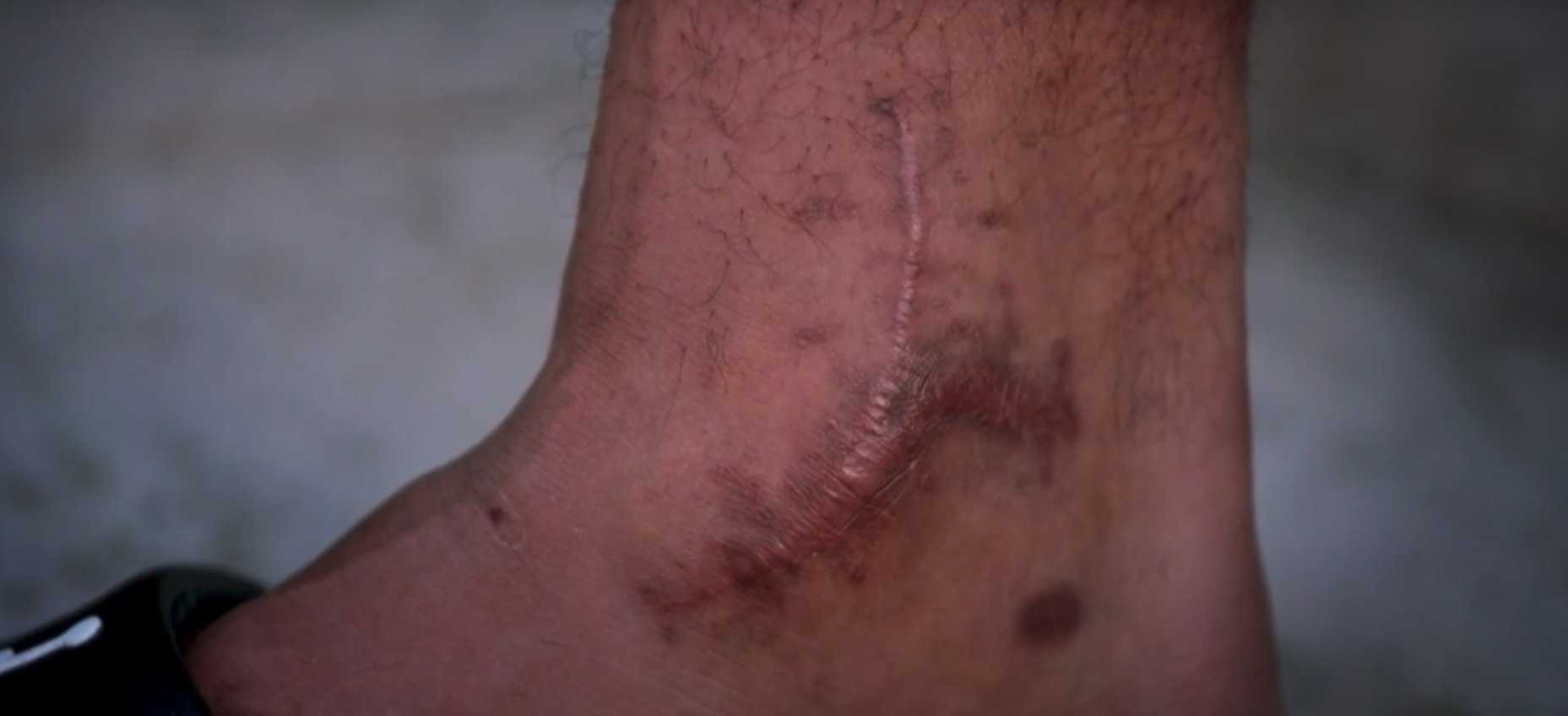 Lesión de Dak Prescott 