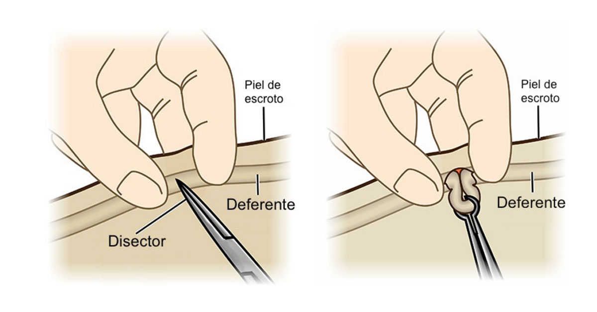 vasectomia-sin-bisturi-procedimiento