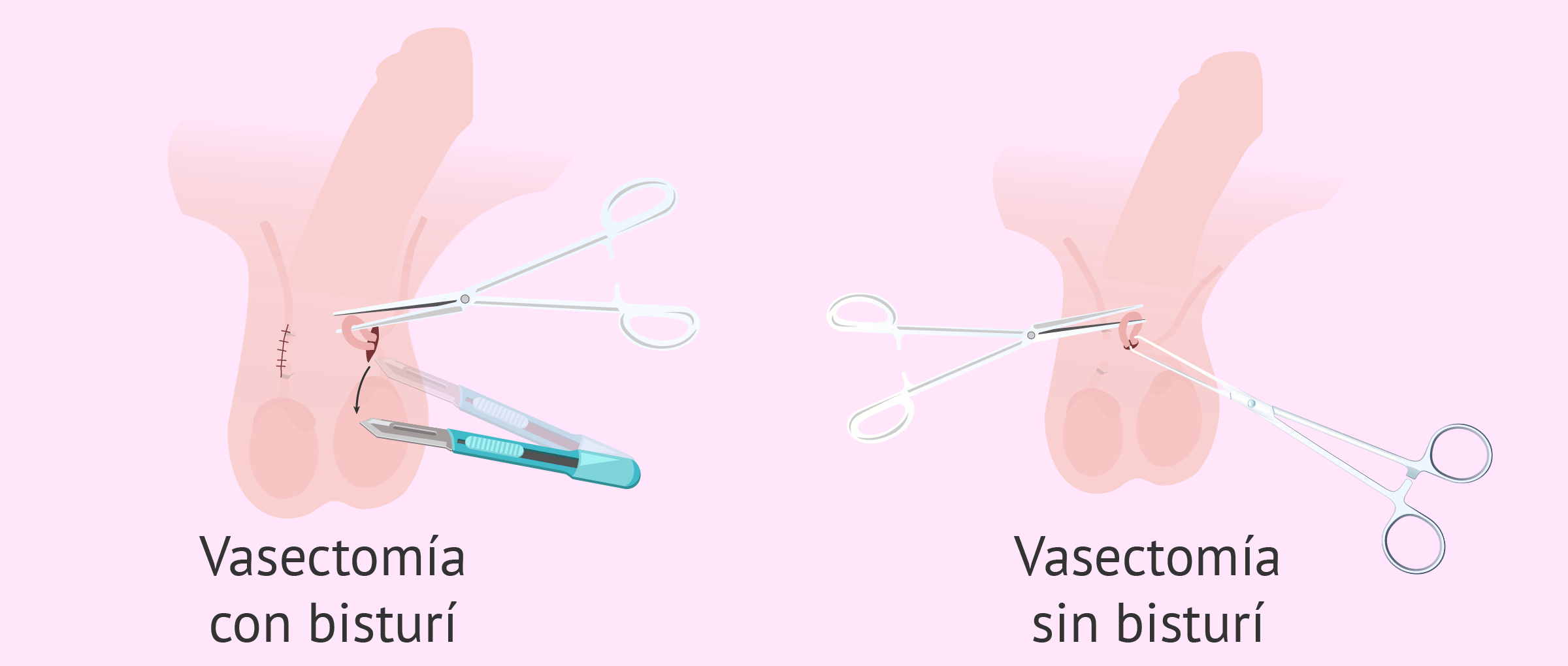 vasectomía-sin-bisturi