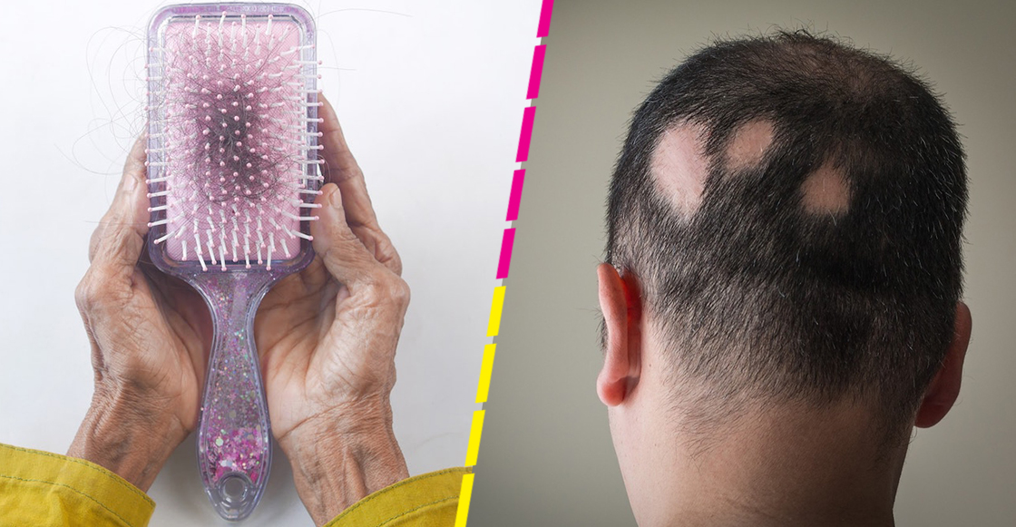 Aprueban primera pastilla la caída de por alopecia en Unidos