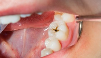 caries-perder-diente-mexico-adultos-estadisticas-salud-dental-bucal