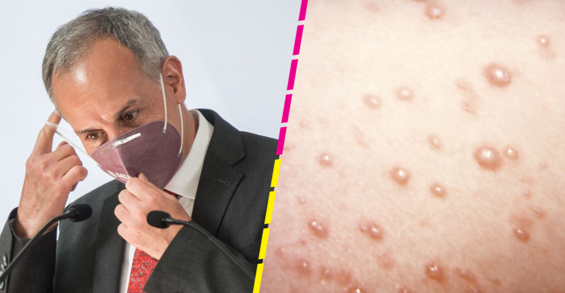 Hugo López Gatell confirma el segundo caso de viruela de mono en CDMX