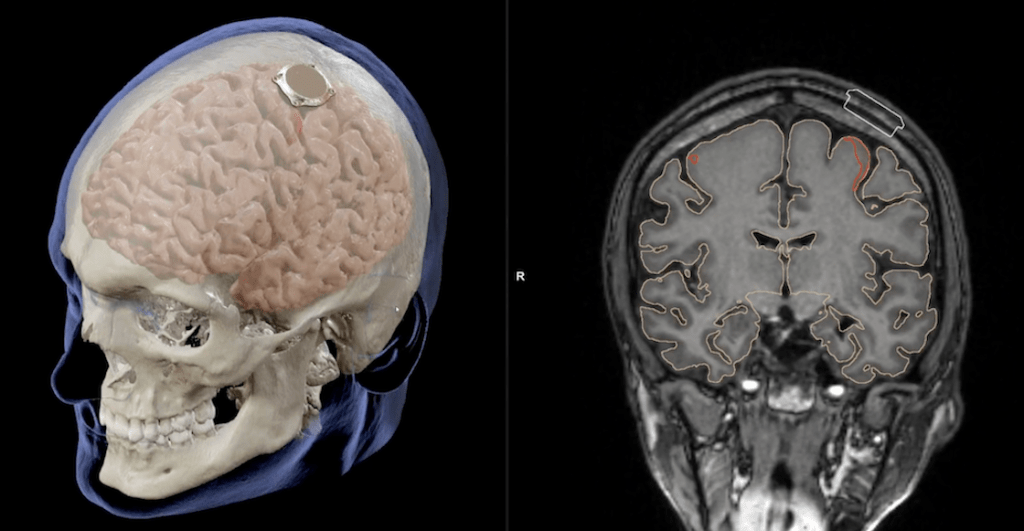 neuralink-busca-primeros-voluntarios-humanos-chip-cerebral-elon-musk-3