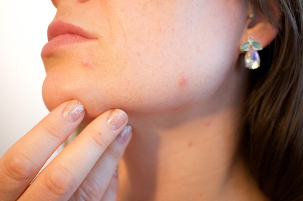 Vacuna contra el acné: Cómo funciona y cuándo estará lista