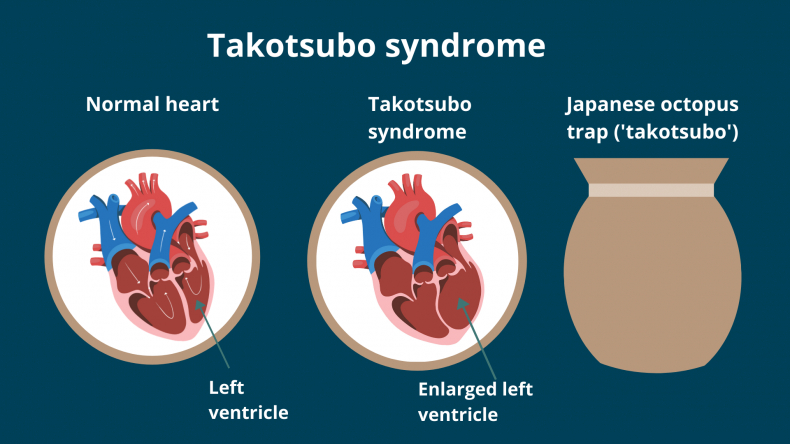 Es por eso que se llama miocardiopatía de Takotsubo