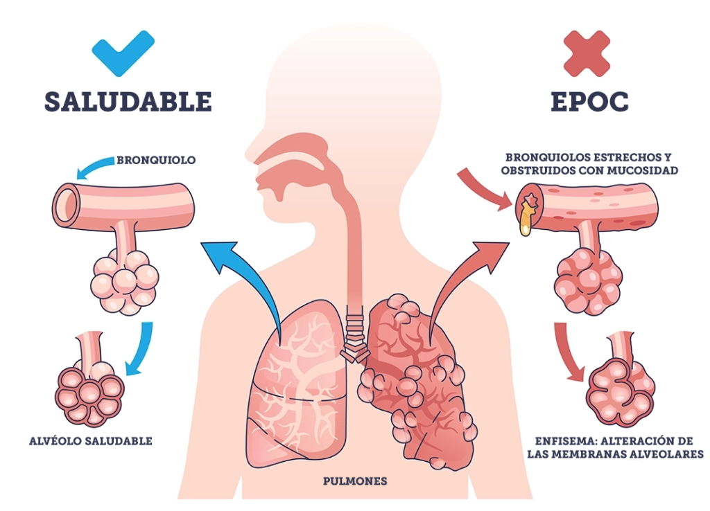 Así se ven pulmones sanos frente al EPOC.