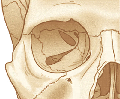 Fractura orbital