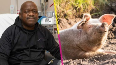Paciente que recibió riñón de cerdo muere y resurge la duda por los xenotrasplantes