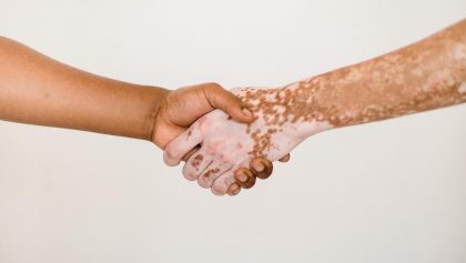 ¿Por qué importa hablar del vitiligo? Datos y cómo entender la enfermedad