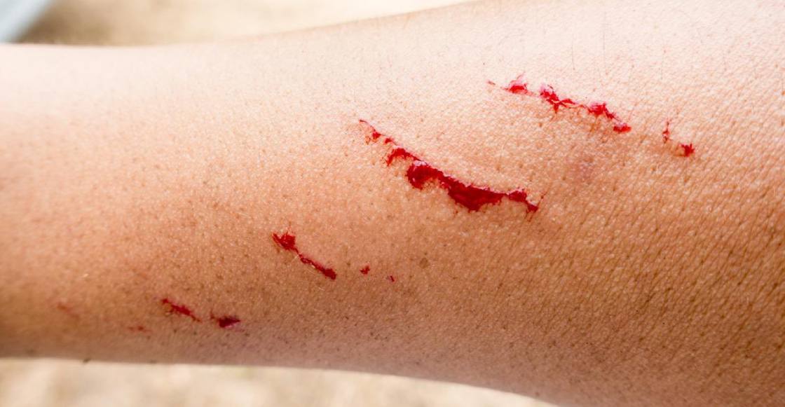 zacatecas-registra-primer-caso-rabia-en-casi-40-anos-1