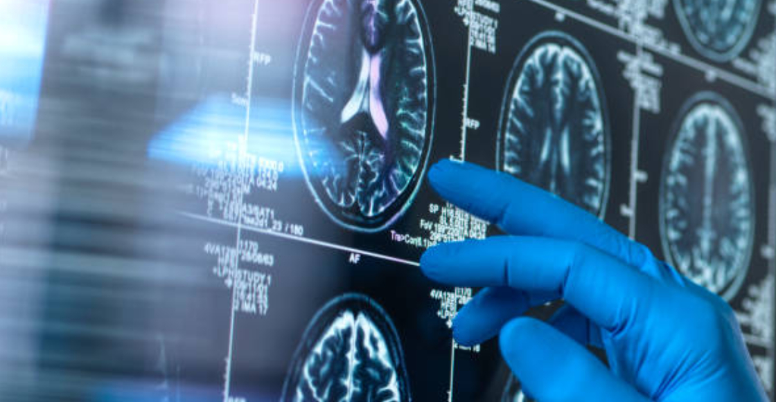 crean-prueba-detecta-alzheimer-antes-sintomas-1