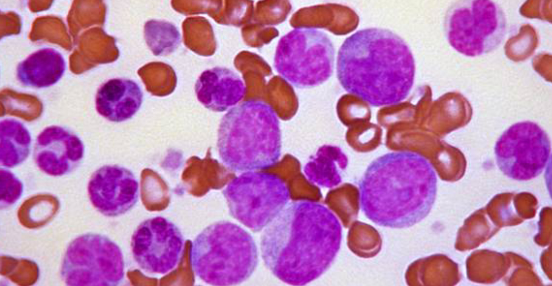 investigadores-ipn-desarrollan-prueba-rapida-detectar-leucemia-infantil-1