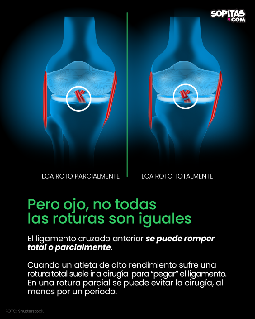 Rotura del ligamento cruzado anterior