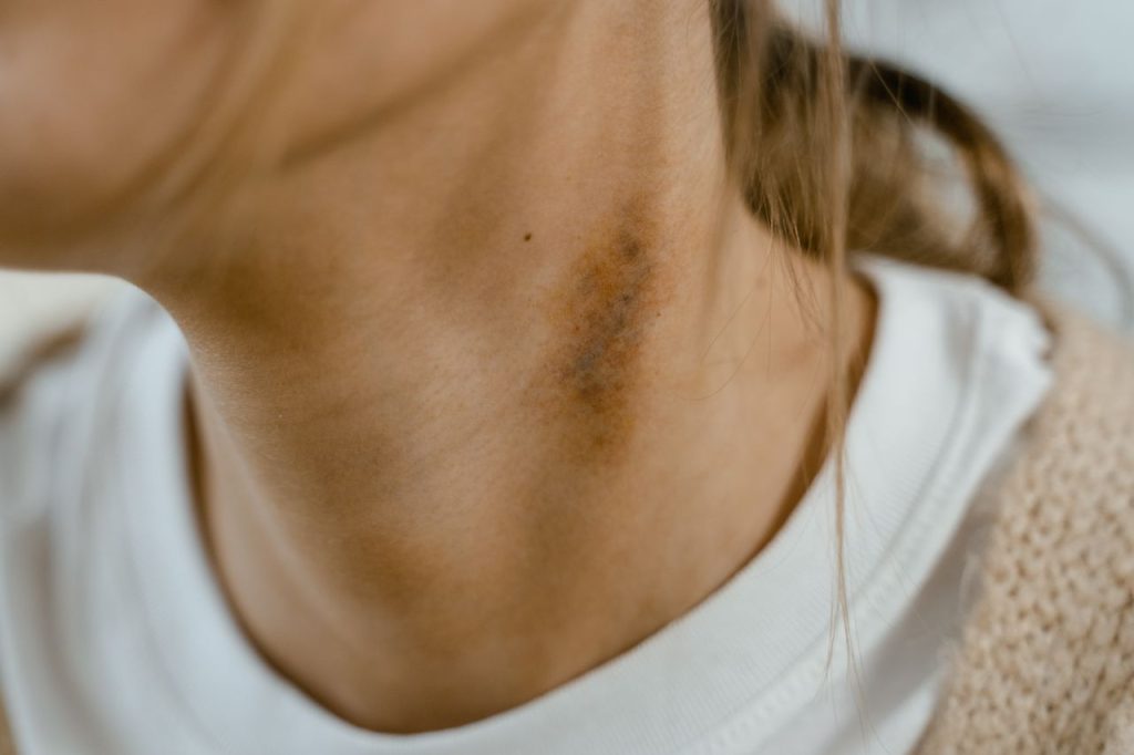 ¿Adiós al melanoma? Moderna y Merk presentan novedosa vacuna contra el cáncer de piel